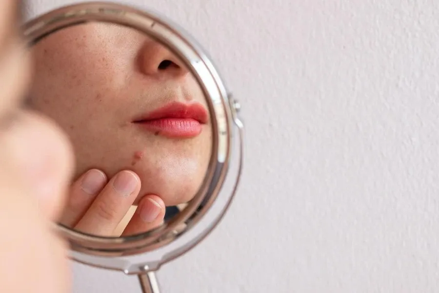 Pessoa examinando a acne no queixo em um espelho redondo.